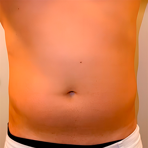 Herus Hifu 4D Herus Hifu 4D