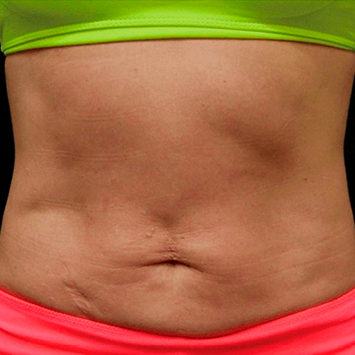 ULTRAFORMER iii ULTRAFORMER iii